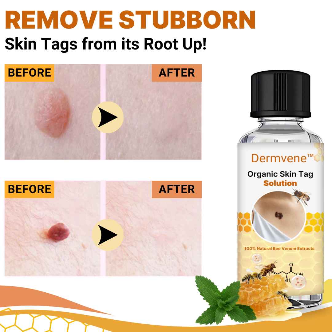 🔥2024 HOT SALE🔥Dermvene™ Organic Skin Tag Solution